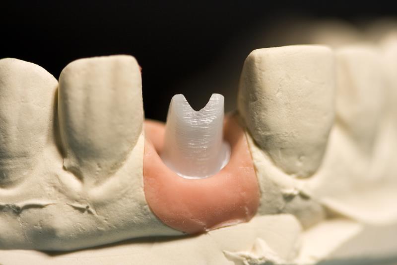 Implant Restoration 