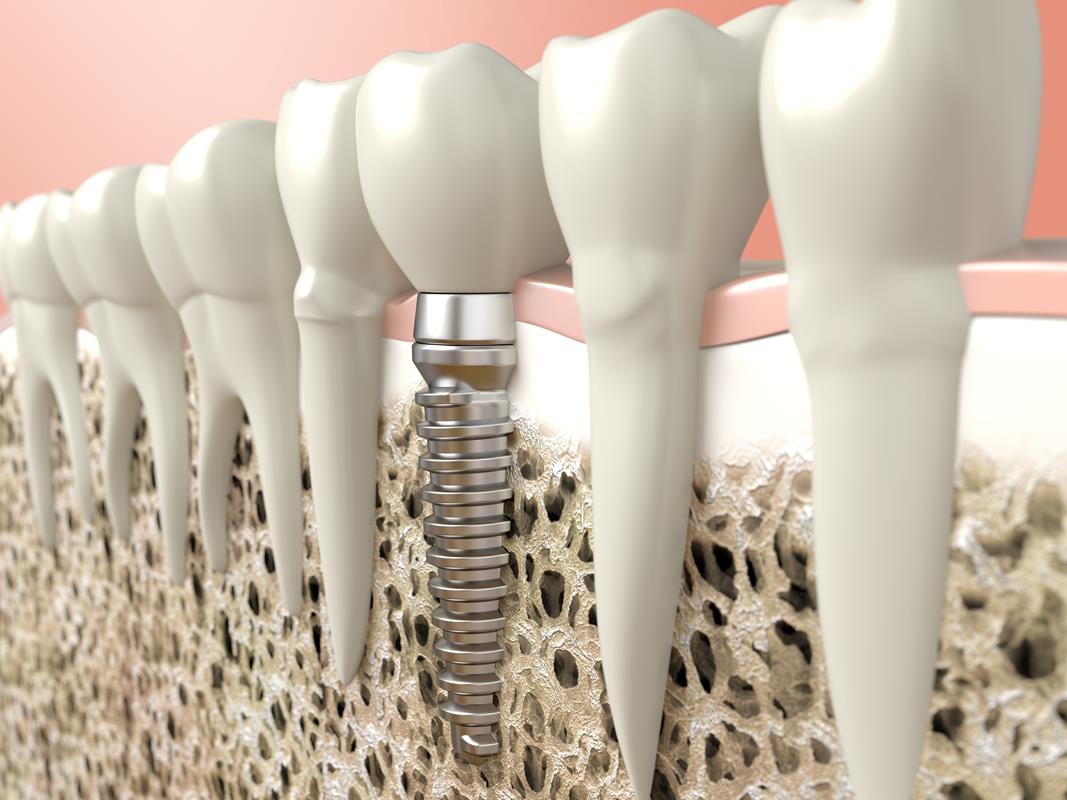 Dental Implants 